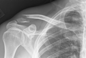 broken collar bone